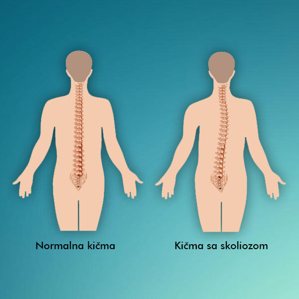 skolioza-centar-29 skolioza-centar-29